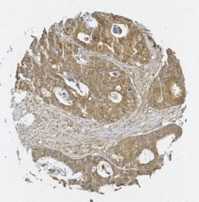 Click to enlarge image Tissue Microarray core of colon cancer immunohistochemically stained with antibody CPTC-RPTOR-2