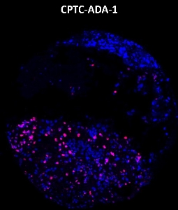 Click to enlarge image Imaging mass cytometry on ovarian cancer tissue core using CPTC-ADA-1 metal-labeled antibody.  Data shows an overlay of the target protein signal (red) and DNA (blue). Dilution: 1:100 of 0.5mg/mL stock Signal was also obtained in other normal tissues (testis, liver, colon, endometrium, appendix, bone marrow, breast, kidney, lung, and placenta) and cancer tissues (breast, colon, prostate, lung, and ovarian).