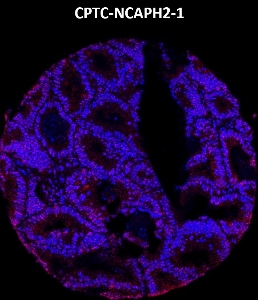 Click to enlarge image Imaging mass cytometry on colon cancer tissue core using CPTC-NCAPH2-1 metal-labeled antibody.  Data shows an overlay of the target protein signal (red) and DNA (blue). Dilution: 1:100 of 0.5mg/mL stock. Signal was also obtained in other normal tissues (liver, colon, endometrium, appendix, breast, kidney, lung, and placenta) and cancer tissues (breast, colon, prostate, lung, and ovarian).
