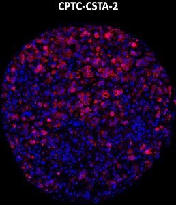 Click to enlarge image Imaging mass cytometry on breast cancer tissue core using CPTC-CSTA-2 metal-labeled antibody.  Data shows an overlay of the target protein signal (red) and DNA (blue). Dilution: 1:100 of 0.5mg/mL stock. Signal was also obtained in other normal tissues (bone marrow, spleen, breast, lung, testis, and appendix) and cancer tissues (breast and lung).